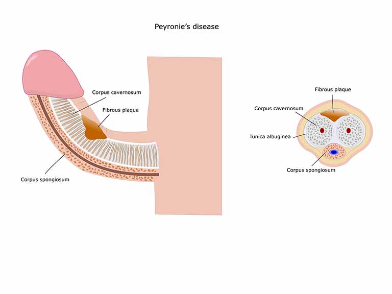 flomax use after prostatectomy