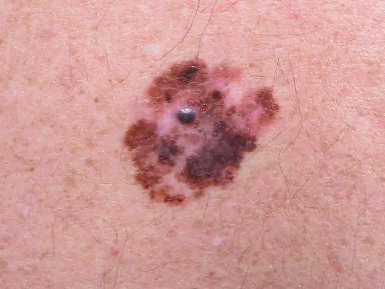 A guide to skin cancers - Saga