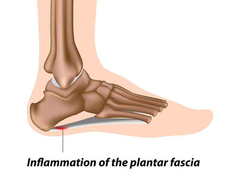 plantar fasciitis shock wave therapy nhs