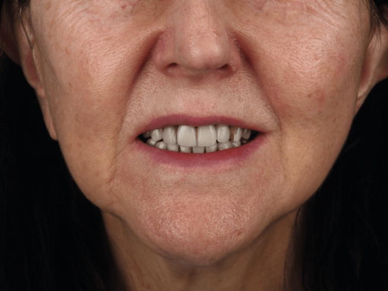 Liz Jones teeth before