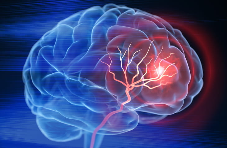 An image of a brain with an area of red illustrating a stroke in progress