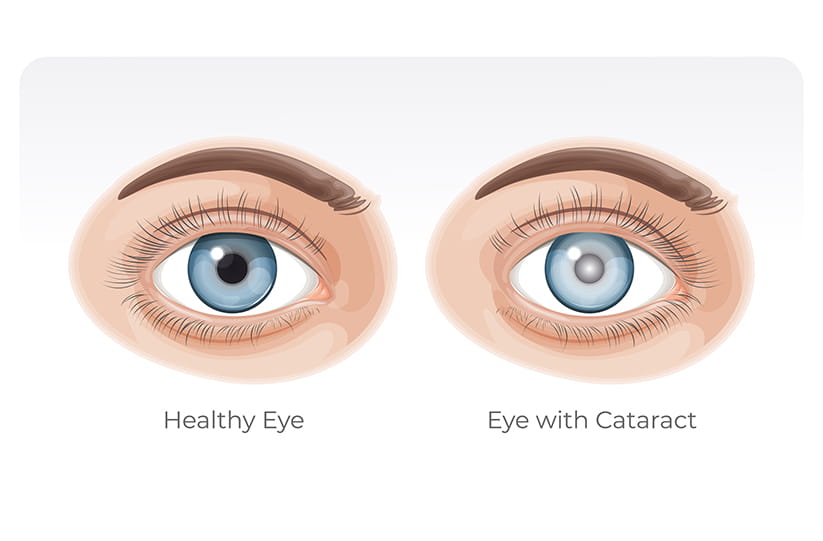 An illustration of the difference between a healthy eye and one with a cataract
