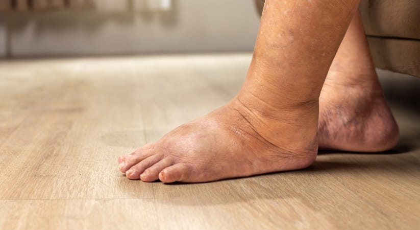 Close up of two bare feet one of which uis swollen