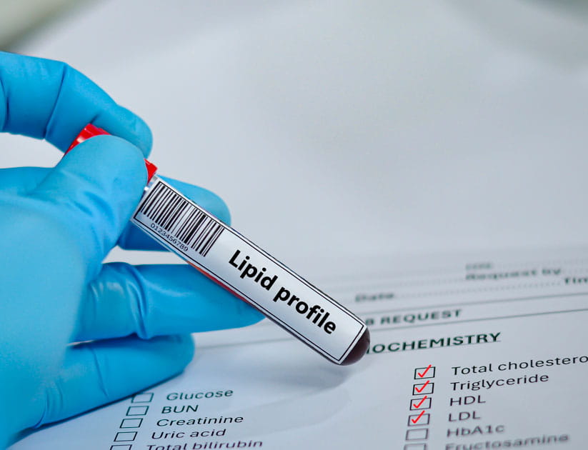 Blood sample tube and paper order request for lipid profile test analysis