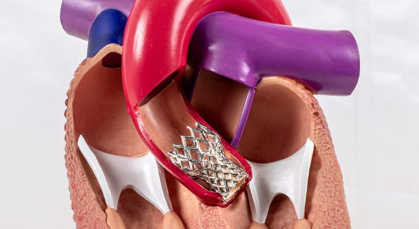 Close up illustration of an aortic valve replacement inside a heart